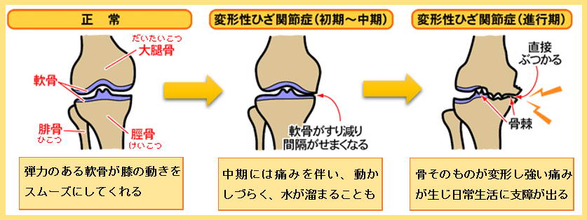 変形性ひざ関節症